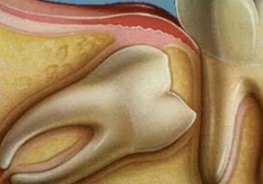 Endodontia terceiros molares (sisos) - Marcelo Guimarães Dentista Divinópolis, Cajuru, Itaúna e Região