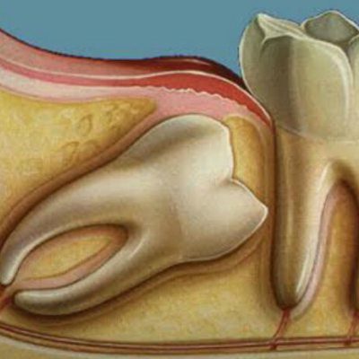 Endodontia terceiros molares (sisos) - Marcelo Guimarães Dentista Divinópolis, Cajuru, Itaúna e Região