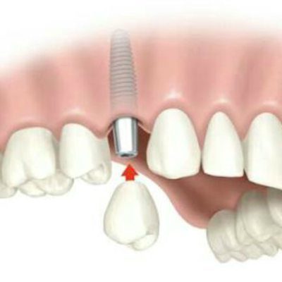 Implantes Unitários - Dr Marcelo Guimarães - Carmo do Cajuru Divinópolis MG