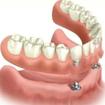 Dr Marcelo Guimarães - Carmo do Cajuru Divinópolis MG - Overdenture