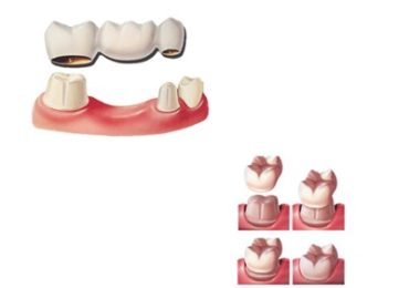 Próteses fixas coroas e pontes - Dr Marcelo Guimarães Cirurgião Dentista - Odontologia MG